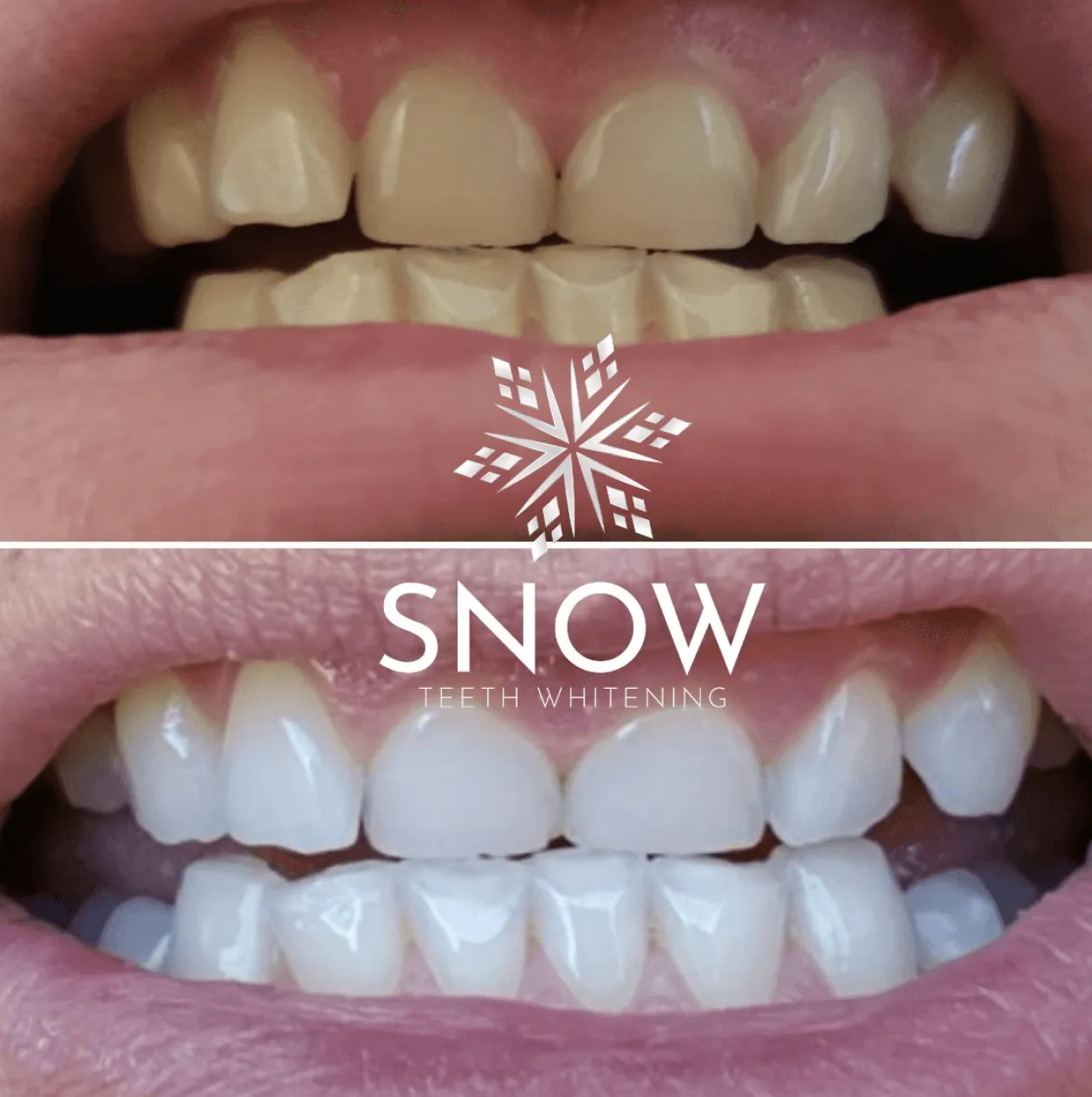 SNOW Teeth Whitening   Lip Balm Bundle